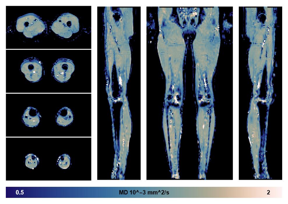 IVIM corrected whole leg muscle mean diffusivity obtained from diffusion tensor imaging.